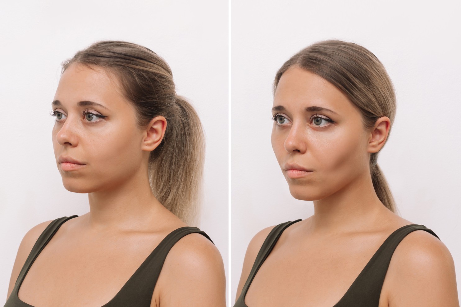 Buccal Fat Removal