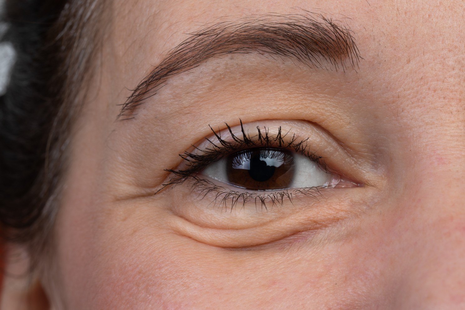 Eyebag Removal