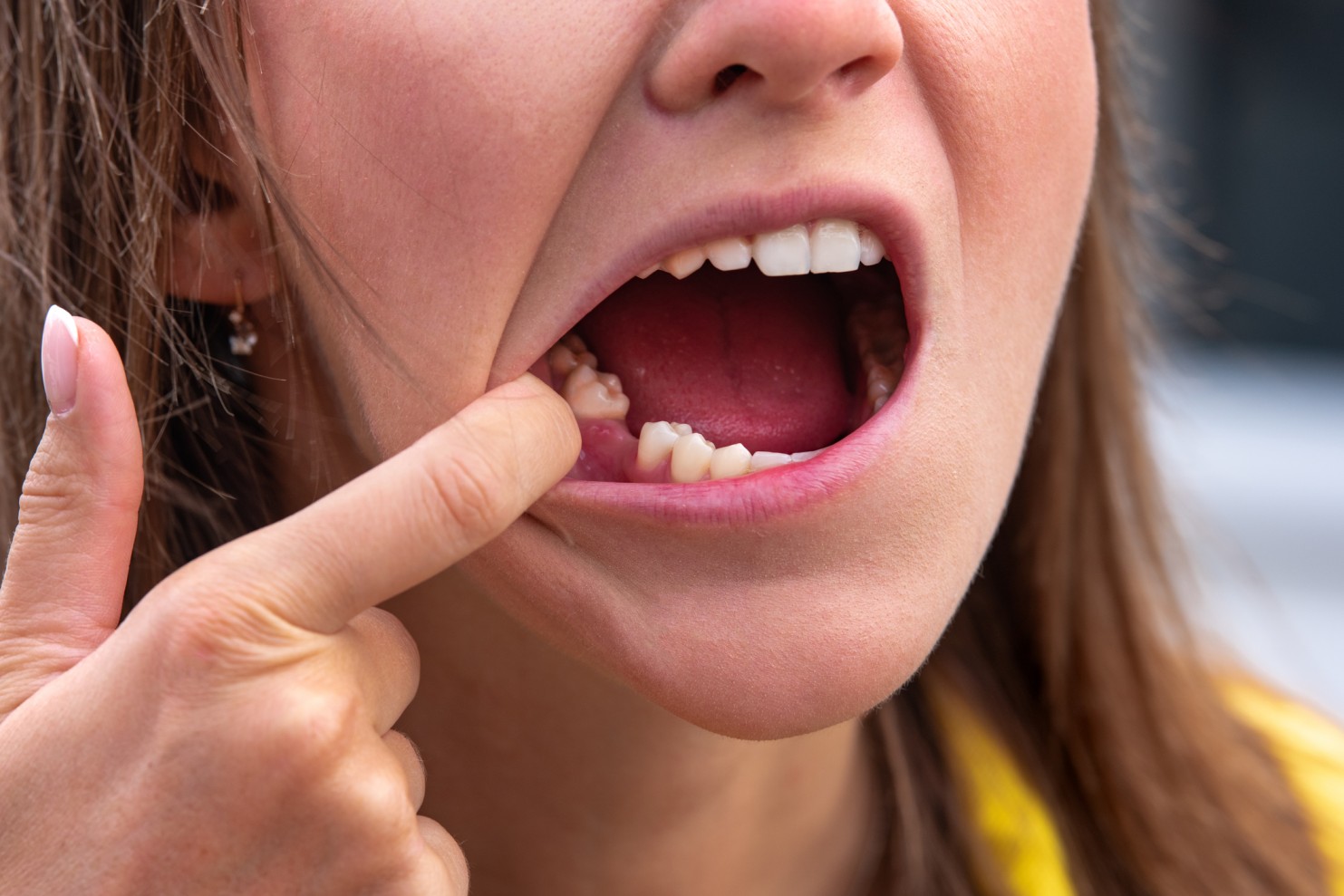 Some Dental Implants Fail Earlier Than Expected