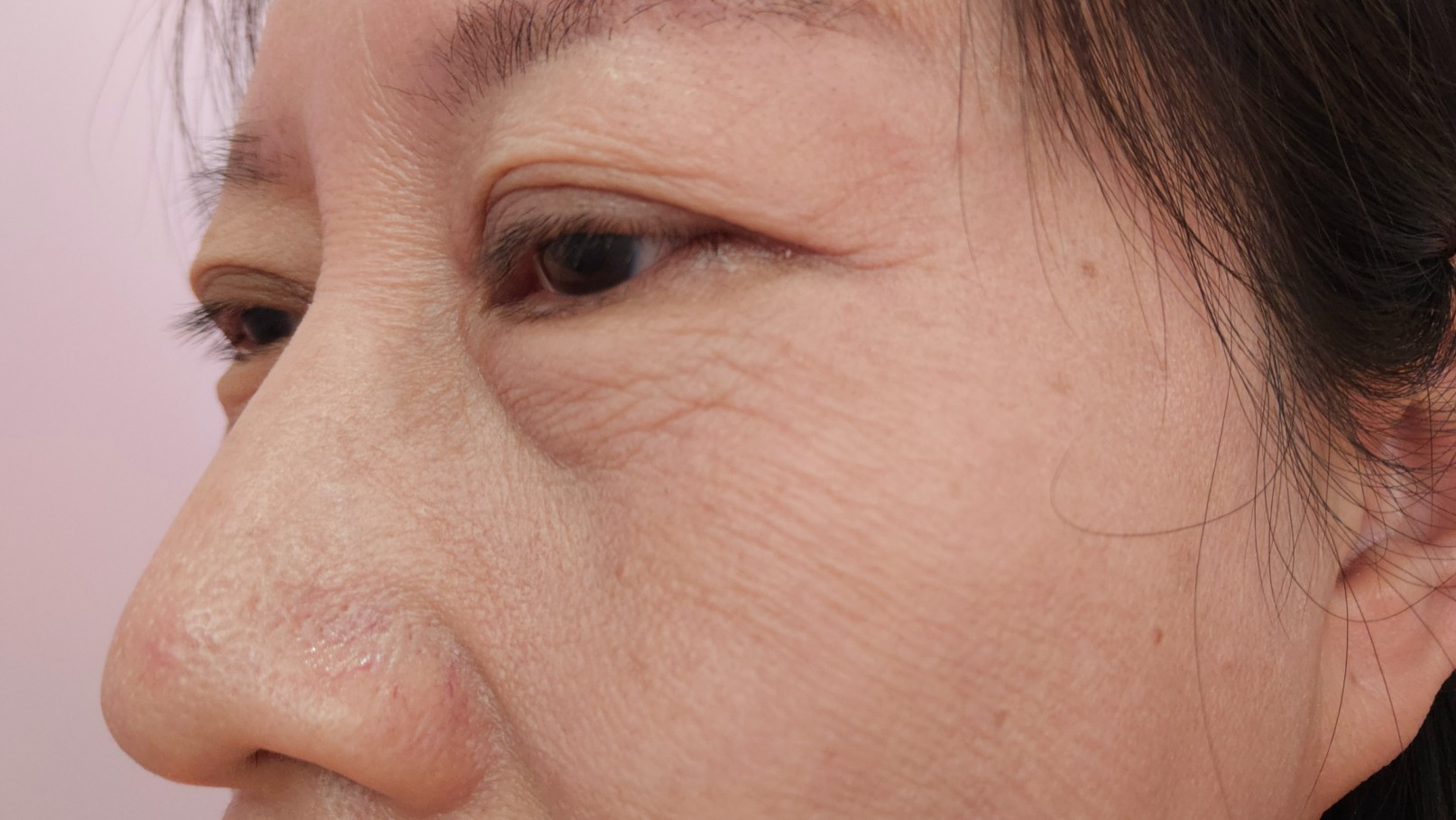 Some Patients Need More Than One Eyelid Procedure